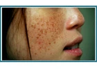 Face Skin Tag Removal – Safe and Gentle Care at London Dermatology Clinics