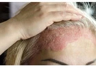 Eczema Rash Treatment in Gurgaon | Skin Experts