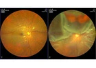Best Retina Surgeon: Protecting Your Vision with Expert Care