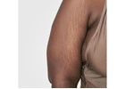 Stretch Marks Treatment Near Me to Fade and Smooth Marks