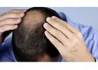 Proven Hair Treatment for Hair Loss – Restore Fullness and Confidence Today