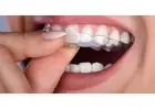 Most Affordable In****lign Cost