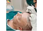 FUE Hair Transplant in Delhi: Restore Your Hair with Confidence | Ayushman Hair Centre