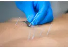 Acupuncture in Singapore for Pain and Stress Relief
