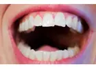How Crowns Teeth Can Improve Your Smile and Oral Health