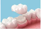 What Is a Dental Crown? Cost, Types & Benefits in Abbotsford