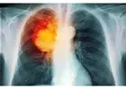 Lung Cancer Donnybrook