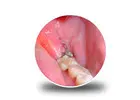 Looking for the Best Wisdom Teeth Removal Services for Comfortable Dental Care?