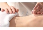 Best Fertility Acupuncture NYC