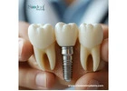 Best Dental Implants Brands in Venezuela – Trusted Picks