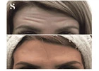 Smooth Away Wrinkles with Expert Botox in Leeds – Serenity Aesthetics