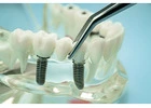 Top-Rated Dental Implant OEM Suppliers for Professionals