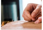 Acupuncture Treatment in Toronto: Simple and Effective Pain Relief