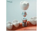 Dental Implant Kits Nicaragua for Skilled Procedures