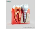 Next-Gen Dental Implant Manufacturers in Venezuela