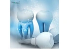 Trusted Dental Implant Suppliers for Mexico Dentists