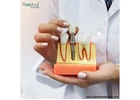 Siiodent Implants: Best Dental Implants Brands In Guatemala
