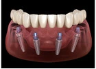 All-on-4 Dental Implants in Tijuana, Mexico – Affordable, Life-Changing Results!
