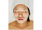 Acupuncture Toronto: Ancient Healing Therapy at King Thai Massage