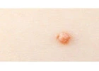 Genital Warts Removal London – Discreet Care at London Dermatology Clinics
