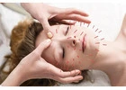Acupuncture in Toronto: Restore Wellness with Every Needle Point