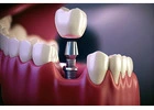 Restore Your Smile with Best Dental Implants in Mumbai