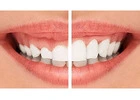 Top Dentist in Gurgaon – Ministry of Smile for Complete Dental Care