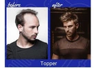 Restore Your Confidence with Professional Hairline Replacement | worldhairinstitute