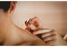 Best Acupuncture Treatment in Steeles: Rediscover Balance through Traditional Therapy