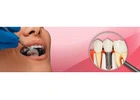 Affordable Dental Implants in India