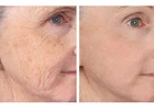 Fractionated CO2 Laser for Acne Scars & Pigmentation in Altamonte Springs, Orlando, Daytona Beac