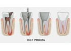 Save Your Tooth – Advanced Root Canal Treatment in Noida