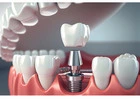Popular Dental Implant Clinic in India