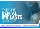 Best Dental Implants in Gurgaon – Ministry of Smile