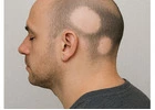 Reliable Alopecia Areata Treatment in Noida for Patchy Hair Loss
