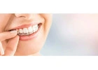 A Clear Guide to Invisible Braces Cost in Gurgaon