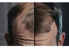 Best Hair Loss Treatment to Restore Hair Health and Confidence